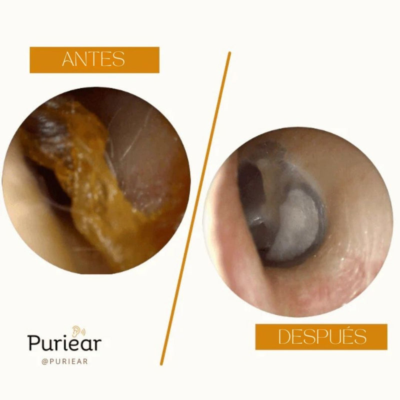 Limpiador Avanzado de Cerumen - Puriear
